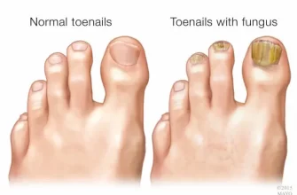 Онихомикоз (грибок ногтей) - симптомы и лечение